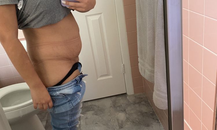 Abdominoplastia y el bbl el mismo día? - 49684