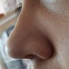 Cómo tratar callo tras rinoplastia secundaria - 49708