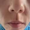 Surcos sobre labio superior tras infiltrar ácido hialuronico
