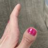 Cirugía reconstructiva de dedo pulgar
