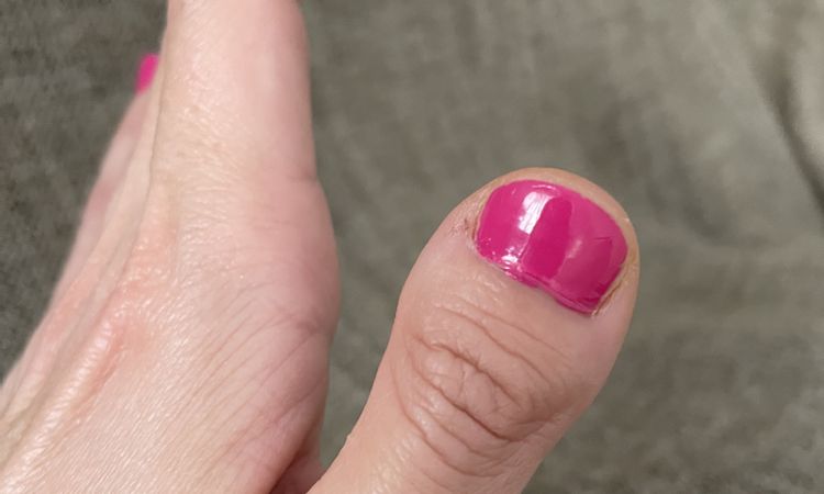 Cirugía reconstructiva de dedo pulgar - 49915