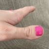 Cirugía reconstructiva de dedo pulgar