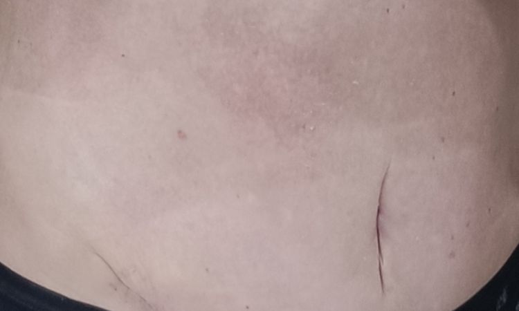 Umbilicoplastia después de abdominoplastia - 49984