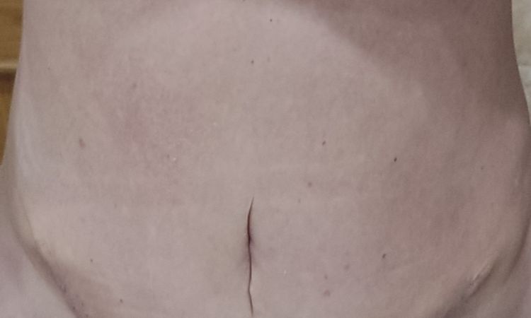 Umbilicoplastia después de abdominoplastia - 49985