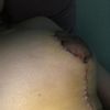 Pecho en forma de cono tras segunda reducción de pecho