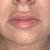 Aumento de labios asimétrico y con bolas - 50139