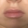 Aumento de labios asimétrico y con bolas - 50140