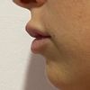 Aumento de labios asimétrico y con bolas - 50141