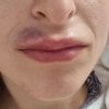 Hematoma tras aumento de labios