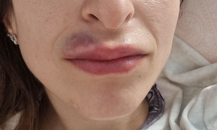 Hematoma tras aumento de labios - 50179