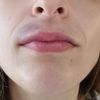 Hematoma tras aumento de labios