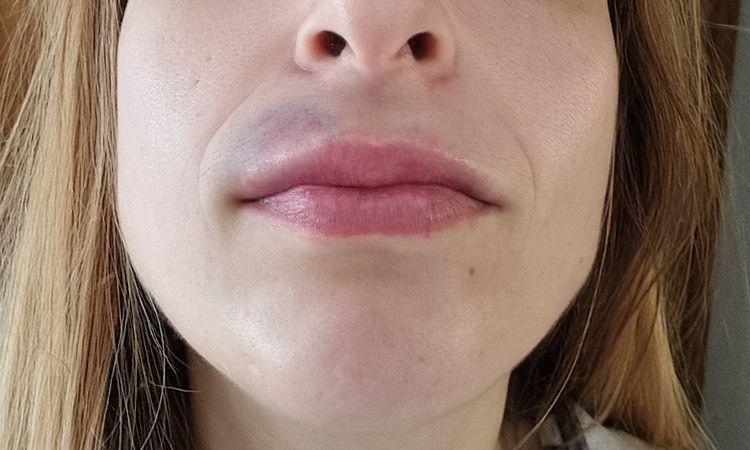 Hematoma tras aumento de labios - 50180