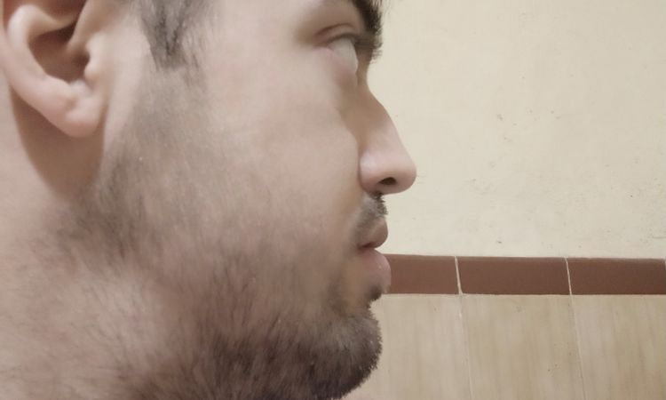 Necesito cirugía ortognática? - 50325