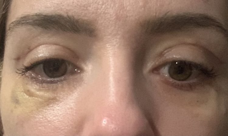 Necesito kenakort para bajar inflamación post blefaroplastia - 50331