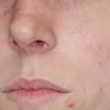 Fosas nasales súper deformadas tras septorrinoplastia - 50459