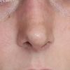 Fosas nasales súper deformadas tras septorrinoplastia - 50460
