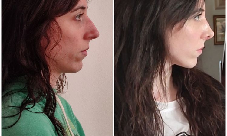Fosas nasales súper deformadas tras septorrinoplastia - 50462