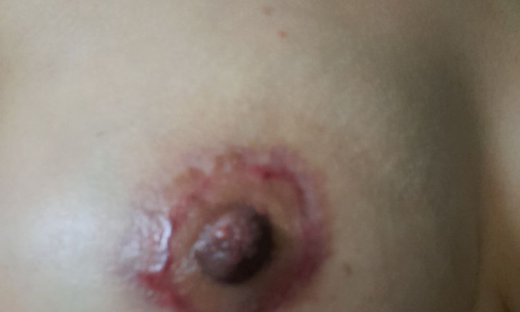 Tratamiento para necrosis parcial areola - 50512