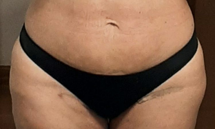 Hendidura en muslo tras lipoescultura Bodytite - 50554