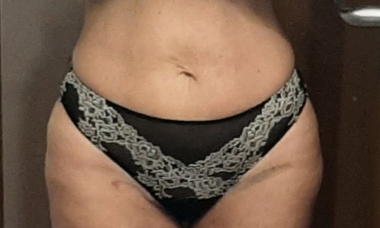 Hendidura en muslo tras lipoescultura Bodytite - 50555