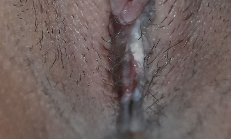 Sangrado e hinchazón en el clítoris por labioplastia - 50558
