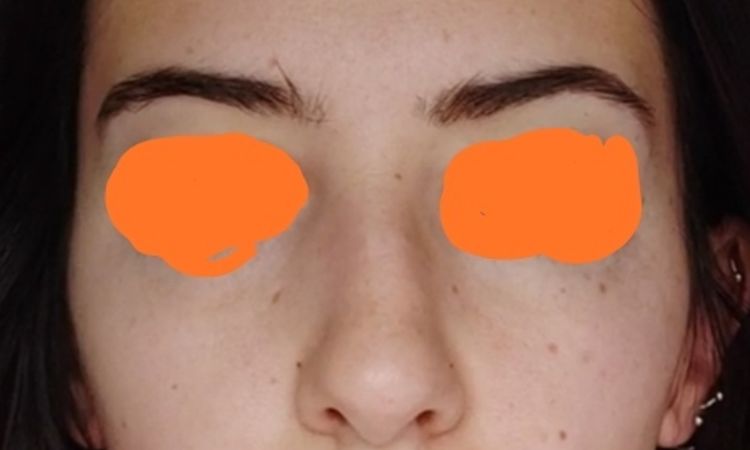 Rellenos faciales para atenuar asimetría facial ósea - 50740