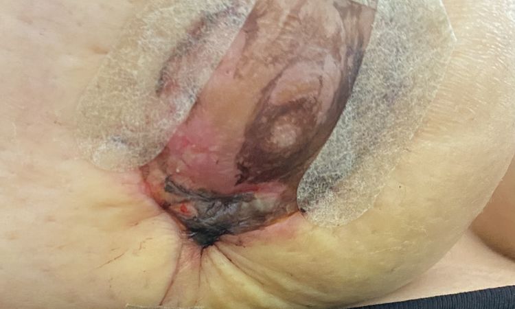 Cirugía de senos para igualar queda totalmente asimétrica - 50950