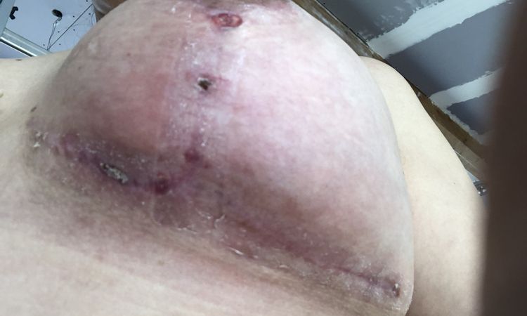 Ampollas y seroma post Mastopexia tras 2 meses - 50972