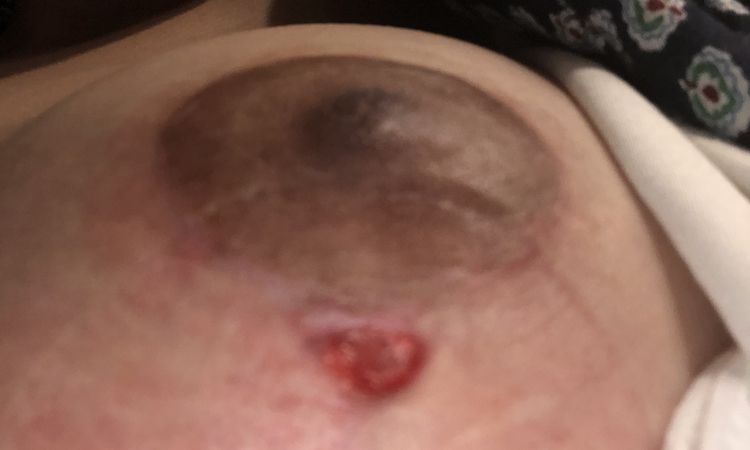 Ampollas y seroma post Mastopexia tras 2 meses - 50973