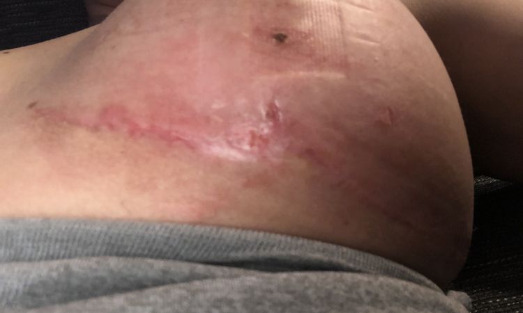 Ampollas y seroma post Mastopexia tras 2 meses - 50974
