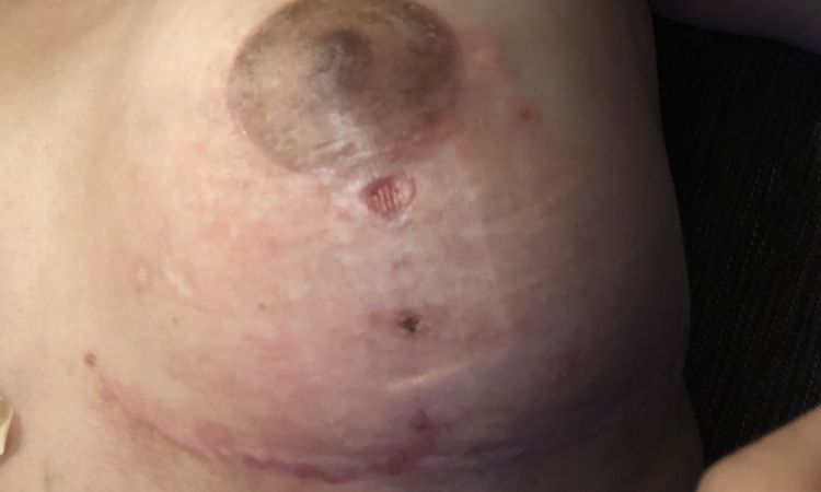 Ampollas y seroma post Mastopexia tras 2 meses - 50975