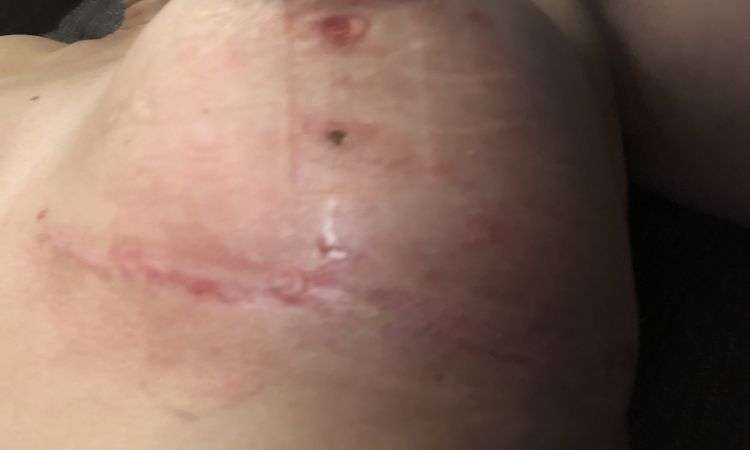Ampollas y seroma post Mastopexia tras 2 meses - 50976