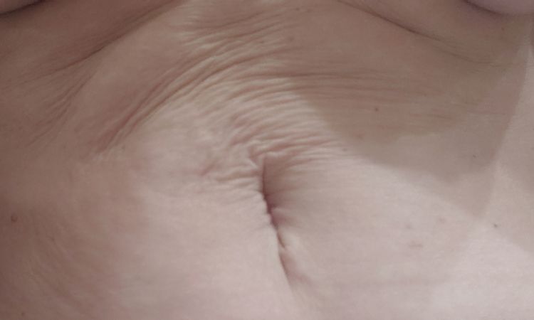 Piel arrugada tras mini abdominoplastia y plicatura - 51048