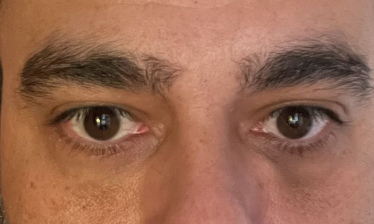 Moratón 1 mes después de inyección de ácido hialuronico en ojeras - 51093