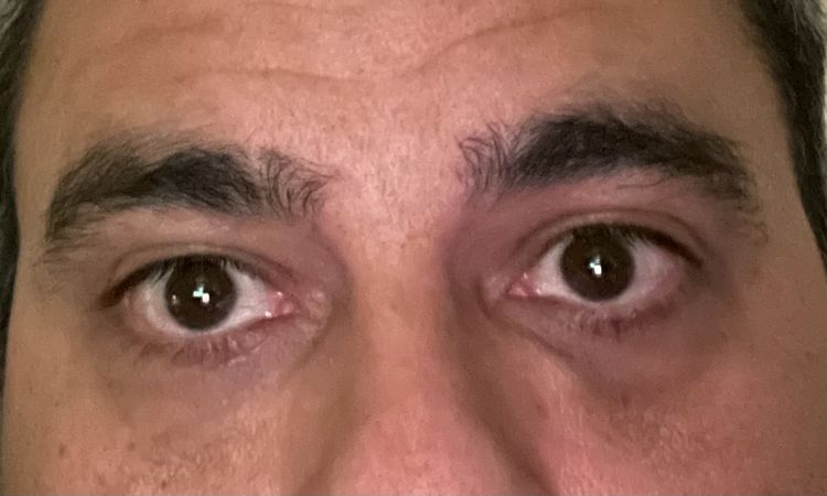 Moratón 1 mes después de inyección de ácido hialuronico en ojeras - 51094