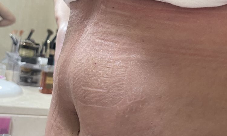 Hematoma supura por el ombligo post abdominoplastia - 51096
