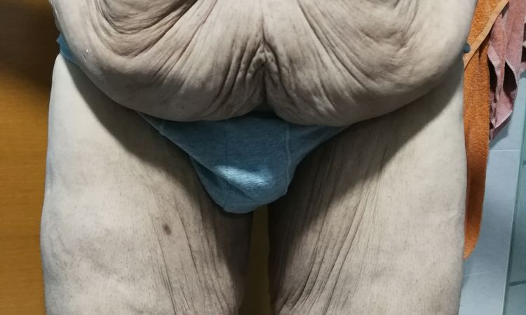 Abdominoplastia 360° completa - 51185
