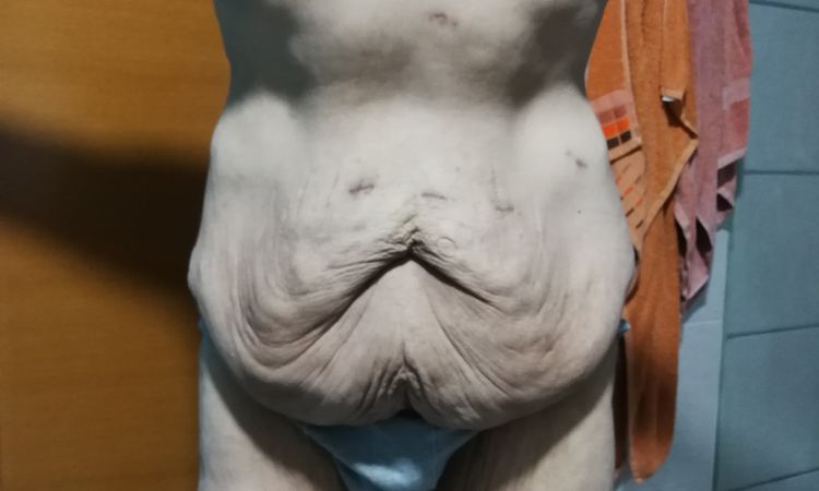 Abdominoplastia 360° completa - 51186