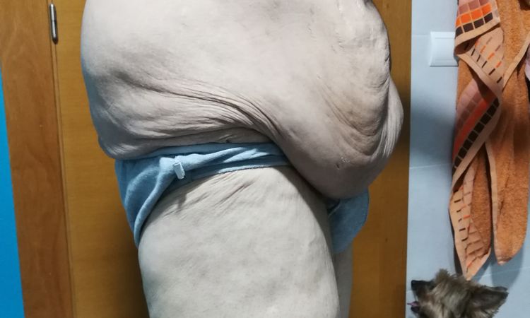 Abdominoplastia 360° completa - 51188