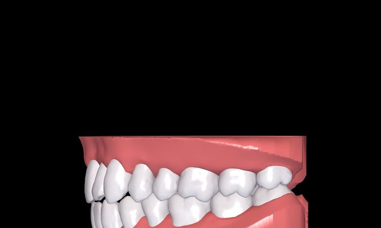 Resultados de simulación 3d Dr Smile - 51248