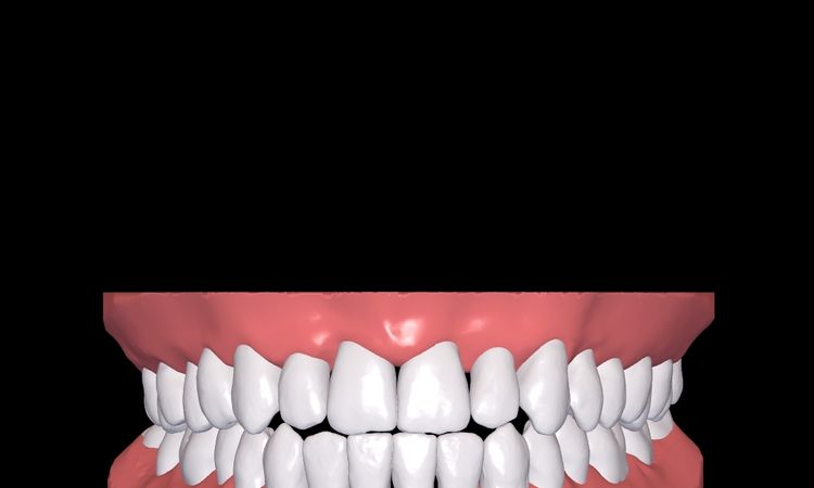 Resultados de simulación 3d Dr Smile - 51250