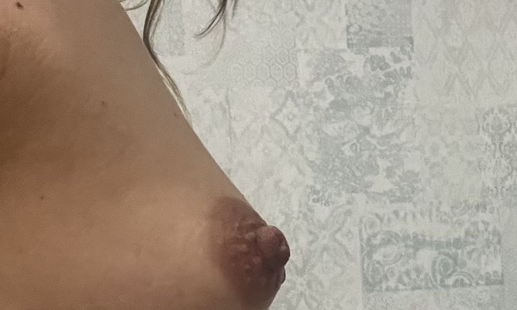 ¿Es posible con este grado de tuberosidad operar por el surco submamario? - 51303