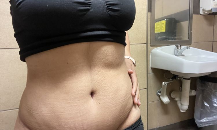 Abultamiento en parte inferior del abdomen a los 6 meses de abdominoplastia - 51328
