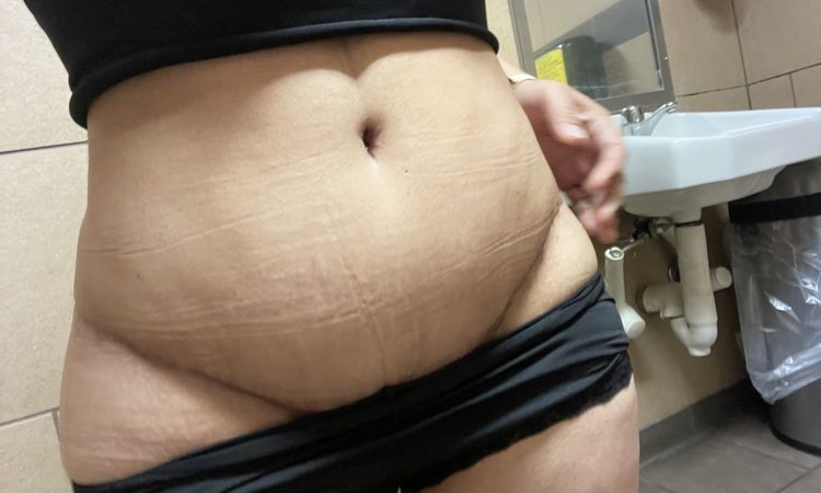 Abultamiento en parte inferior del abdomen a los 6 meses de abdominoplastia - 51329