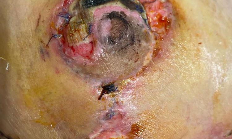 Puntos abiertos en ambas mamas tras mastopexia, heridas muy feas - 51383