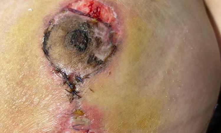 Puntos abiertos en ambas mamas tras mastopexia, heridas muy feas - 51384