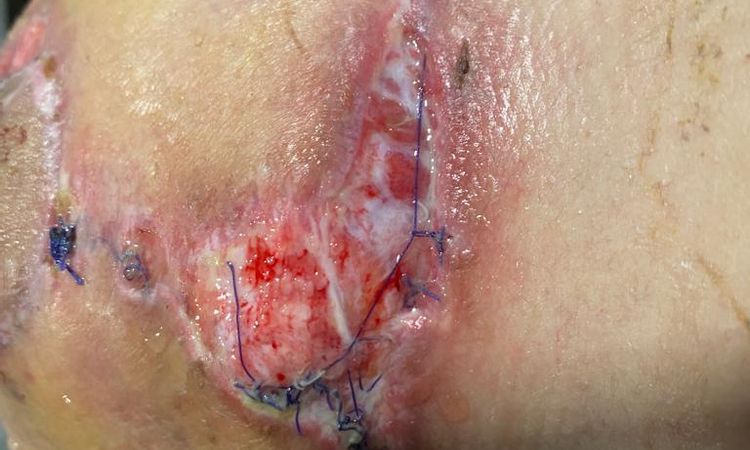 Puntos abiertos en ambas mamas tras mastopexia, heridas muy feas - 51385