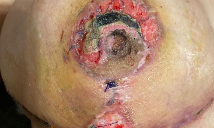 Puntos abiertos en ambas mamas tras mastopexia, heridas muy feas - 51387