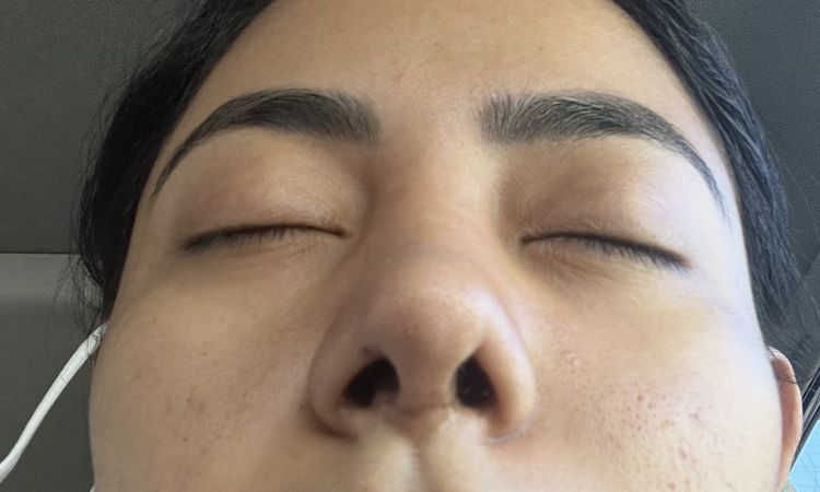 Se nota el injerto de mi rinoplastia - 51389