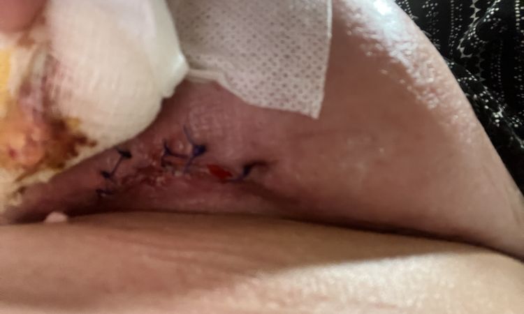 Cómo evitar que se abran los puntos de una mastopexia - 51391